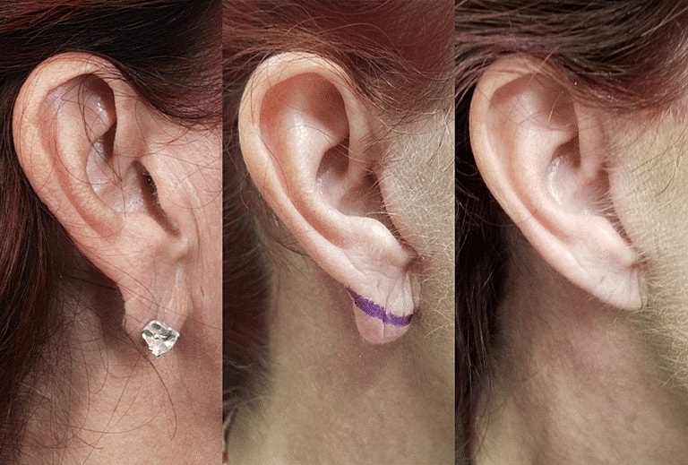 Earlobe Repair Surgeon Washington DC