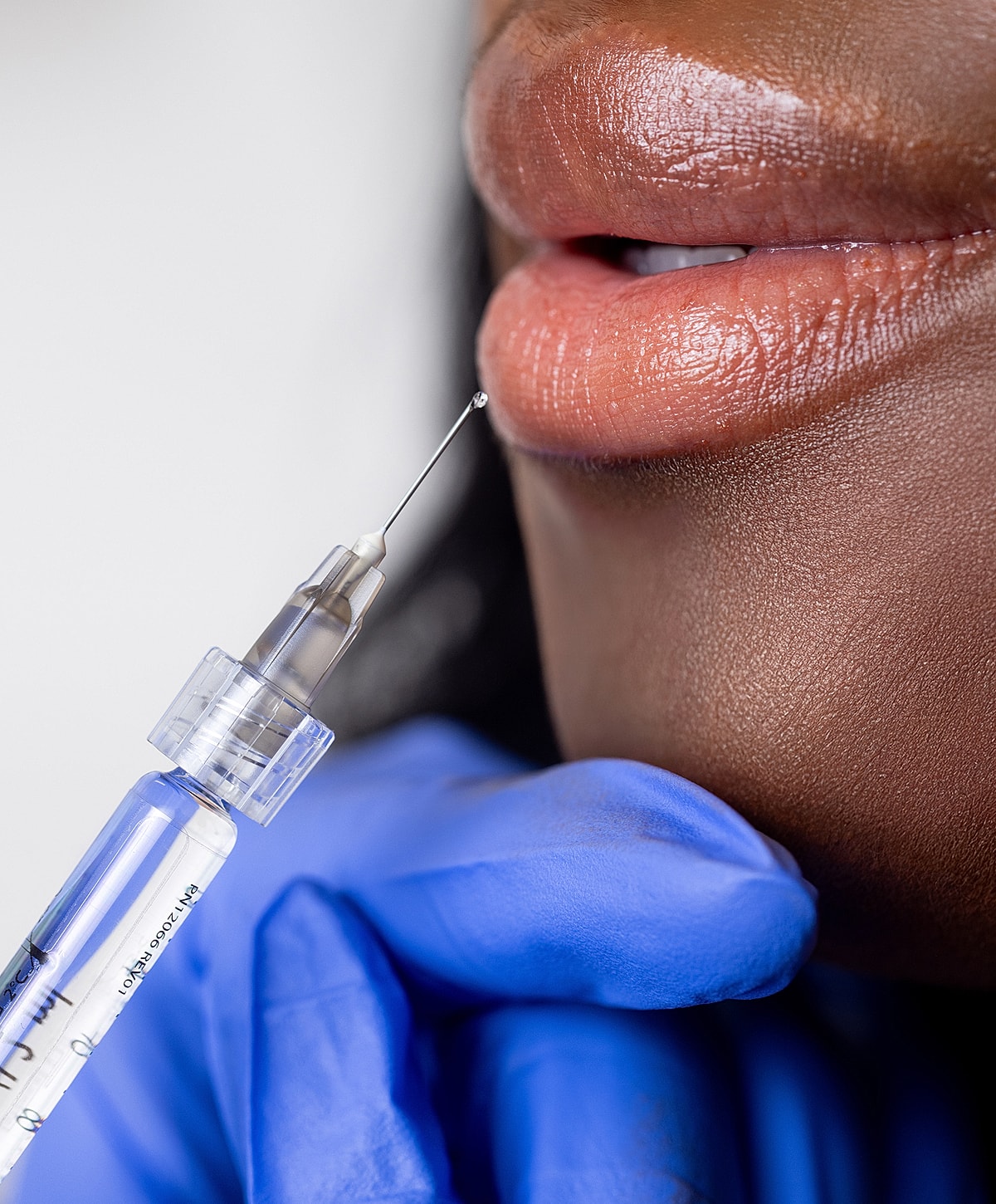 Lip enhancement procedure with syringe and gloved hand