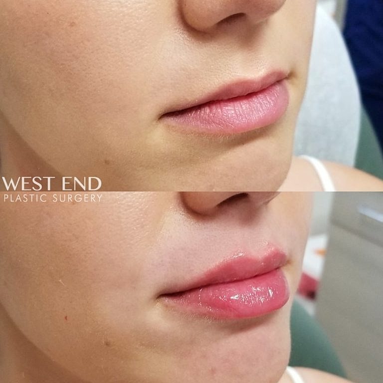 Before and After Image of JUVÉDERM® Treatment Washington DC