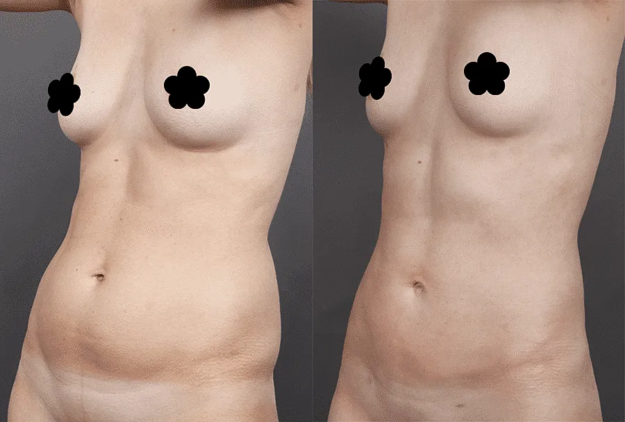 Liposuction Surgery Cost Washington DC