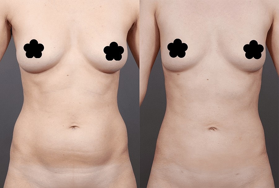 Best Liposuction Doctors Washington DC