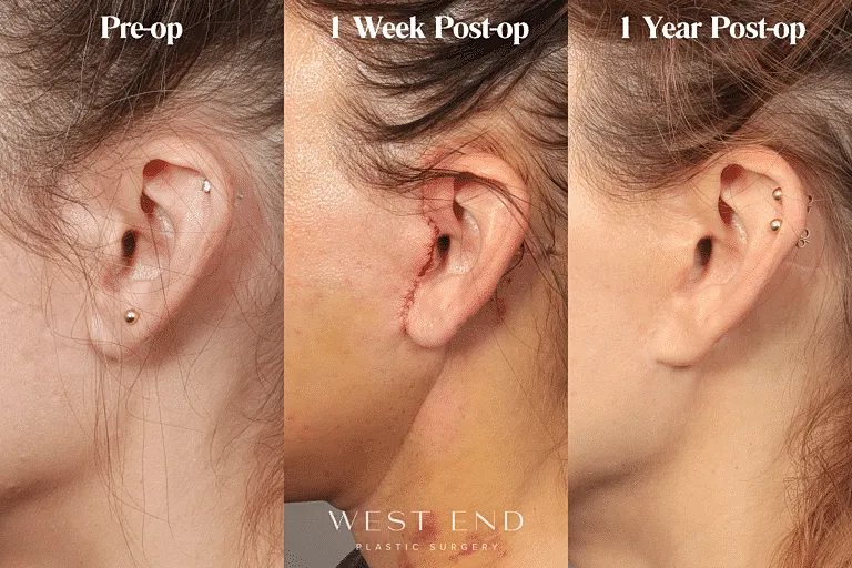 Ear surgery progression: pre-op, one week, one year.