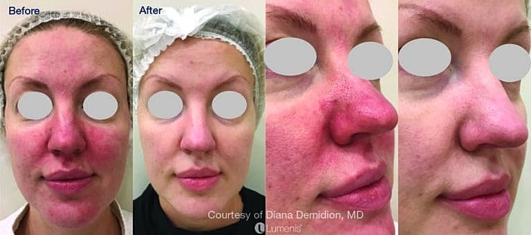 Before and After Image of Intense Pulsed Light Treatment Washington DC