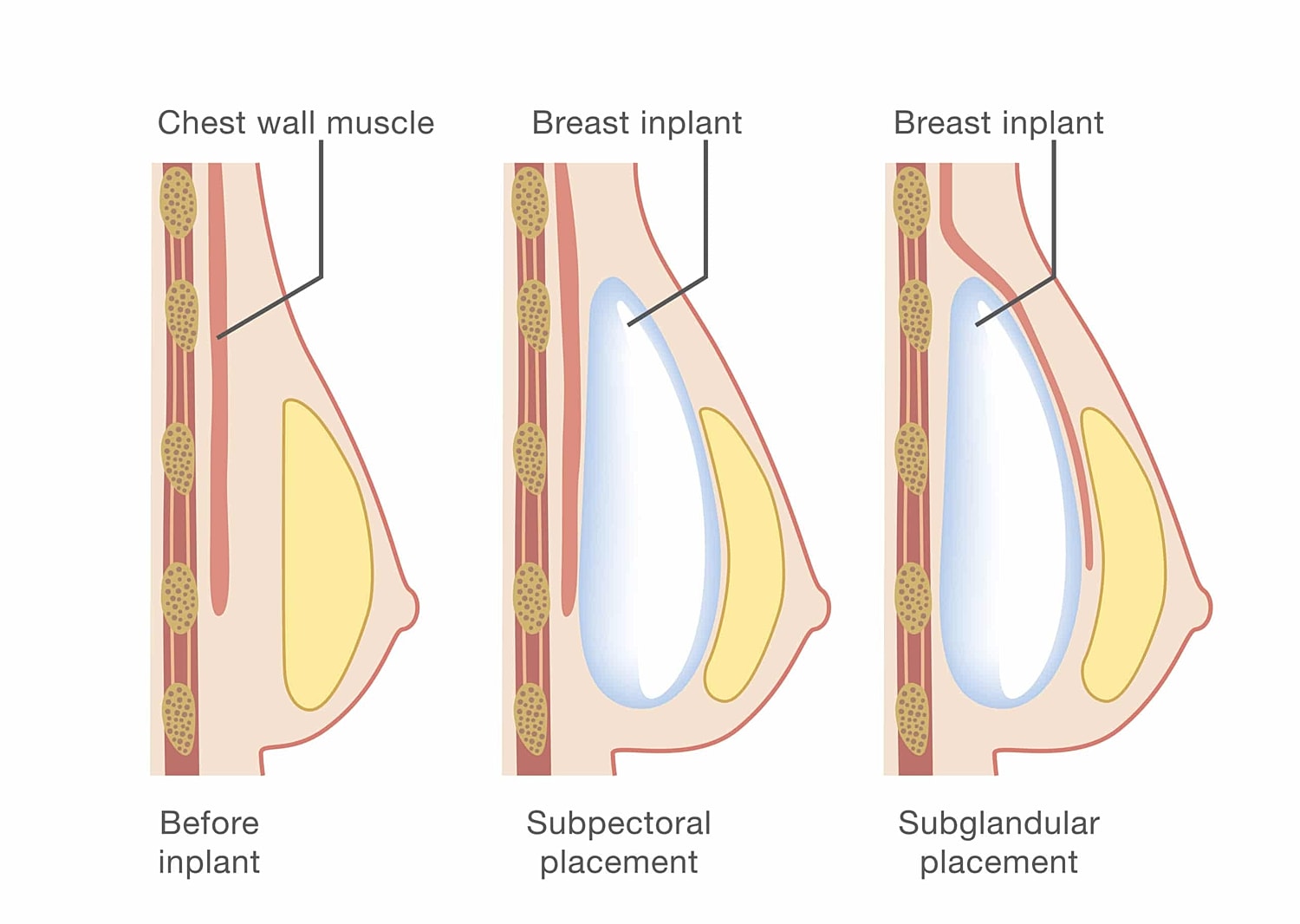 Breast implant placement techniques illustrated diagrammatically.