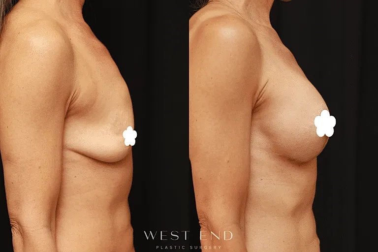 Before and after breast augmentation procedure images.