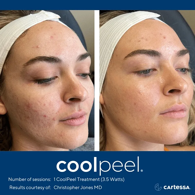 CO2 Laser Resurfacing Before & After Washington DC