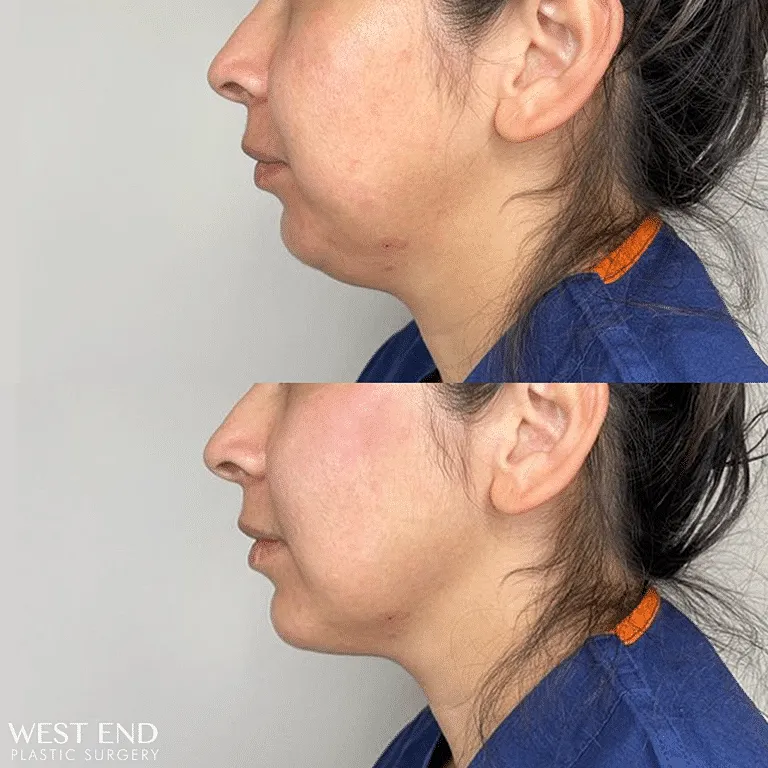 Before and After Image of Juvederm Injections Washington DC