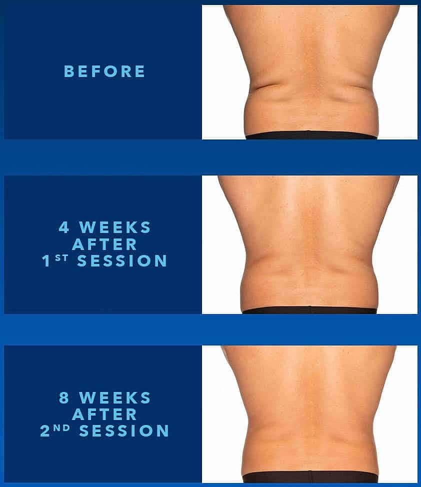 CoolSculpting Treatment Washington DC