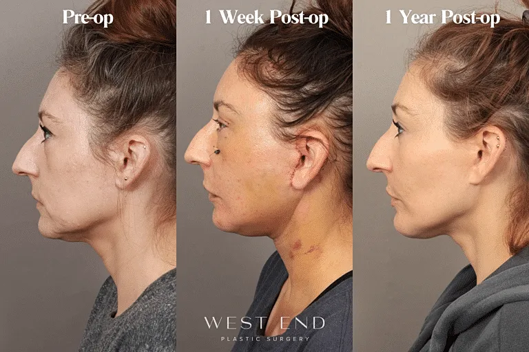 Rhinoplasty recovery timeline: before and after images.
