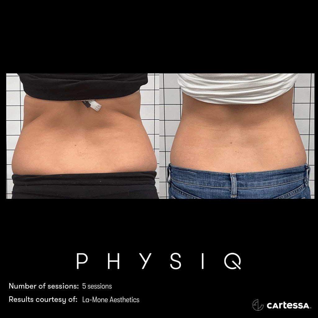 Before and After Image of PHYSIQ Body Contouring Washington DC