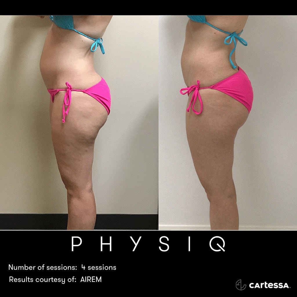 Before and After Image of Body Sculpting Treatment Washington DC