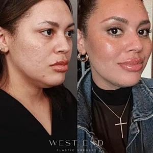 before and after Restylane treatment Washington DC