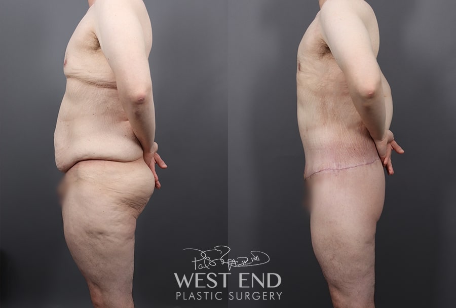Body Lift or Lower Body Lift - American Society of Bariatric Plastic  Surgeons (ASBPS)
