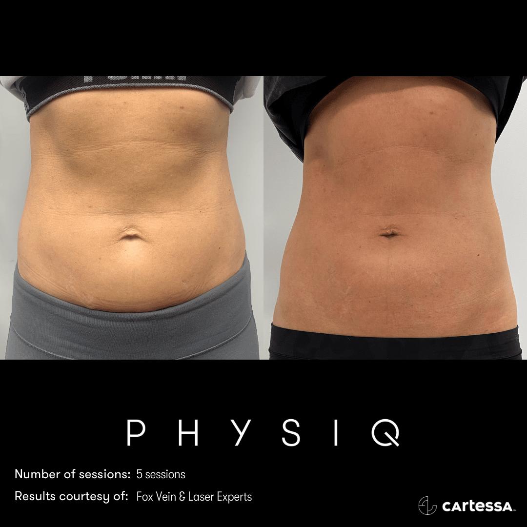2022's Most Popular Body Contouring Treatments - Vein & Laser