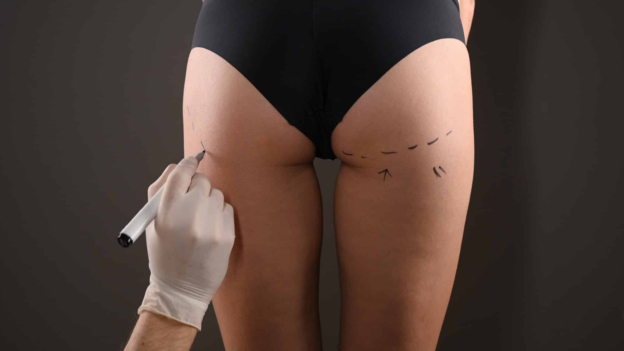 Buttock augmentation, sometimes referred to as a BBL or Brazilian Butt Lift  using your own fat or implants, can surgically increase the s