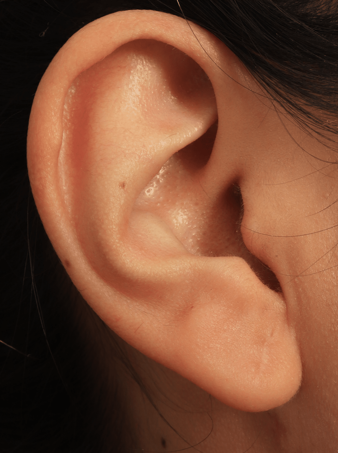 Earlobe Repair Washington Dc Top Earlobe Reduction Surgeon 6570