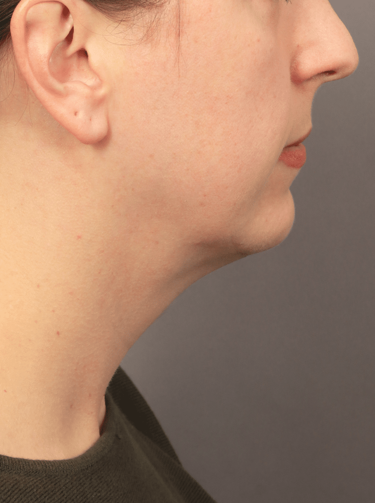 Before Image: Liposuction, Renuvion, and Facial Implants (4.5 Months Post-op) - right-side