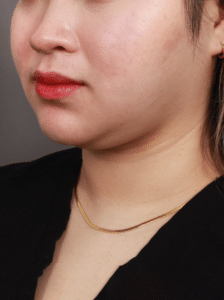 Before Image: Liposuction of the Submental, Jawline, and Neck Region (3 Months Post-Op)