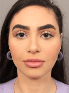 After Image: Rhinoplasty & Facial Fat Grafting (5.5 Months Post-op)