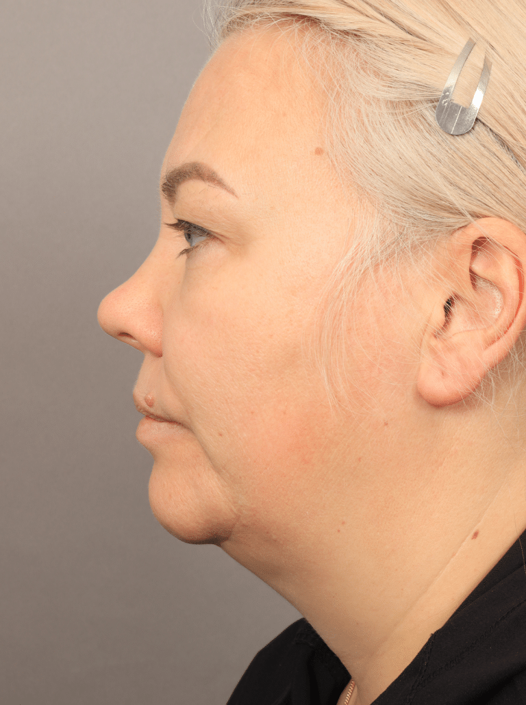 Before Image: Neck Lift with Platysmaplasty, Upper Eyelid Lift, Brow Lift, and CO2 Resurfacing (4 Months Post-op) - left-side