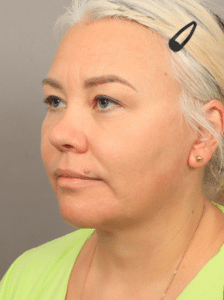 Neck Lift with Platysmaplasty, Upper Eyelid Lift, Brow Lift, and CO2 Resurfacing (4 Months Post-op)