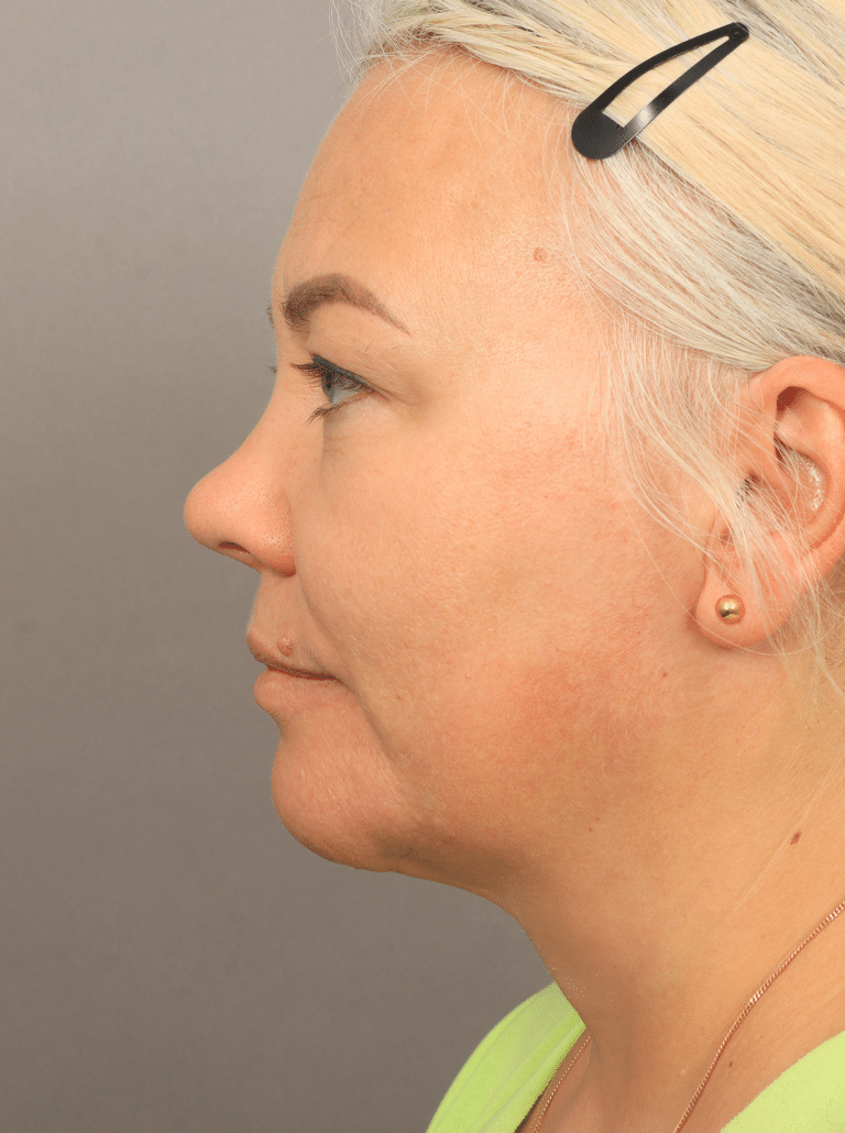 After Image: Neck Lift with Platysmaplasty, Upper Eyelid Lift, Brow Lift, and CO2 Resurfacing (4 Months Post-op) - left-side