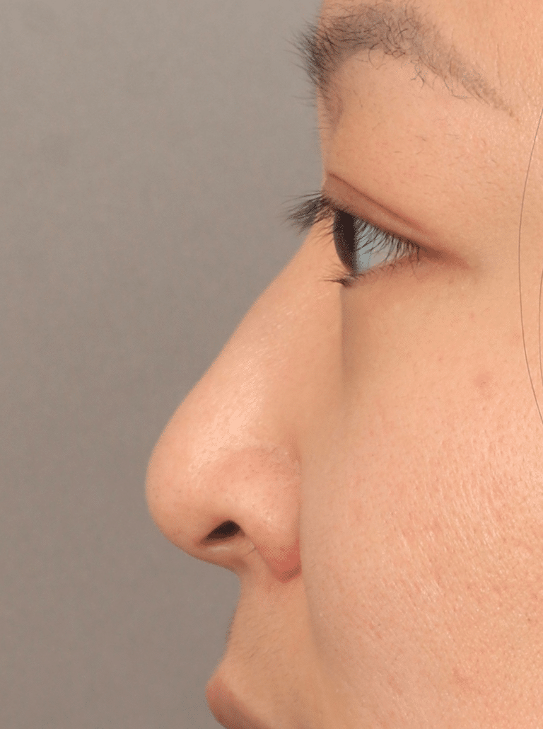 Before Image: Non-Surgical Rhinoplasty (with Filler) - left-side