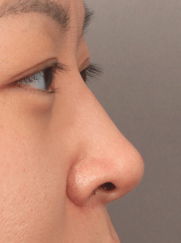 After Image: Non-Surgical Rhinoplasty (with Filler) - right-side