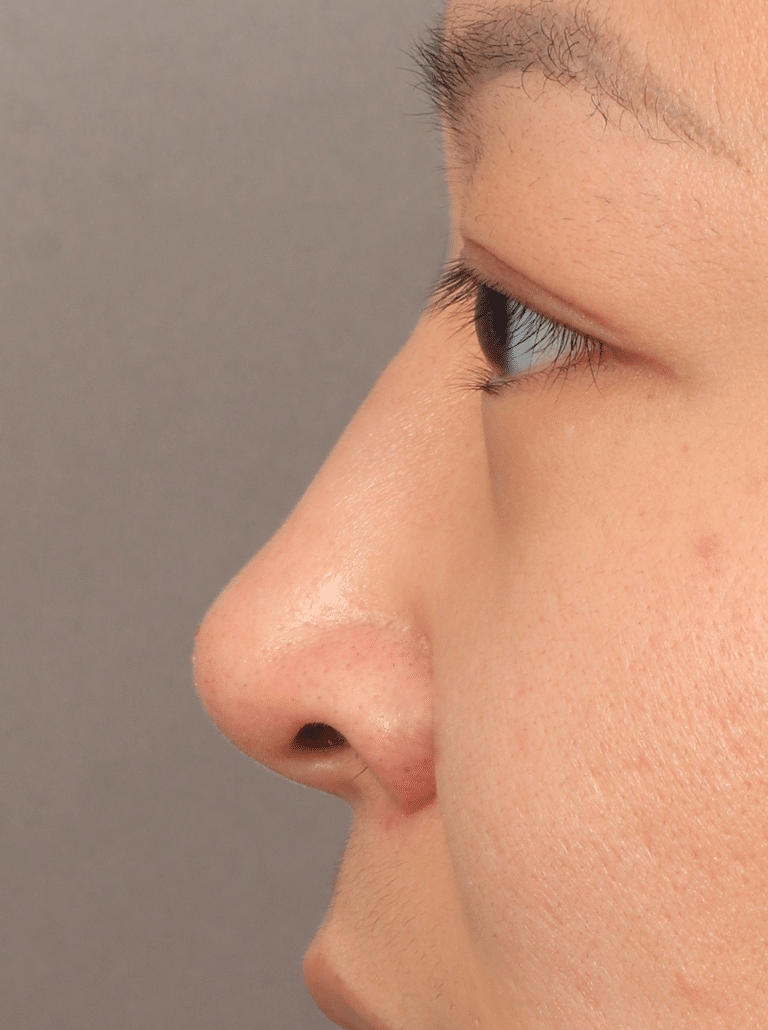 After Image: Non-Surgical Rhinoplasty (with Filler) - left-side