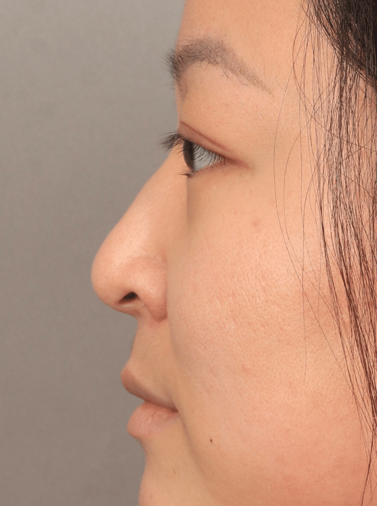 Before Image: Non-Surgical Rhinoplasty (with Filler) - left-side