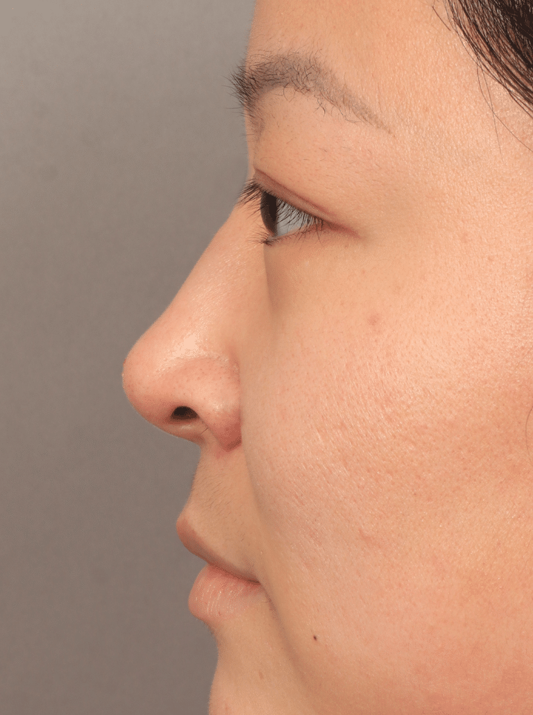 After Image: Non-Surgical Rhinoplasty (with Filler) - left-side