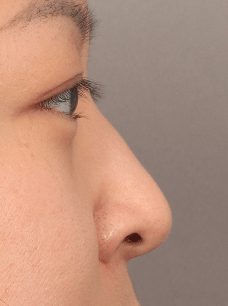 Before Image: Non-Surgical Rhinoplasty (with Filler) - right-side