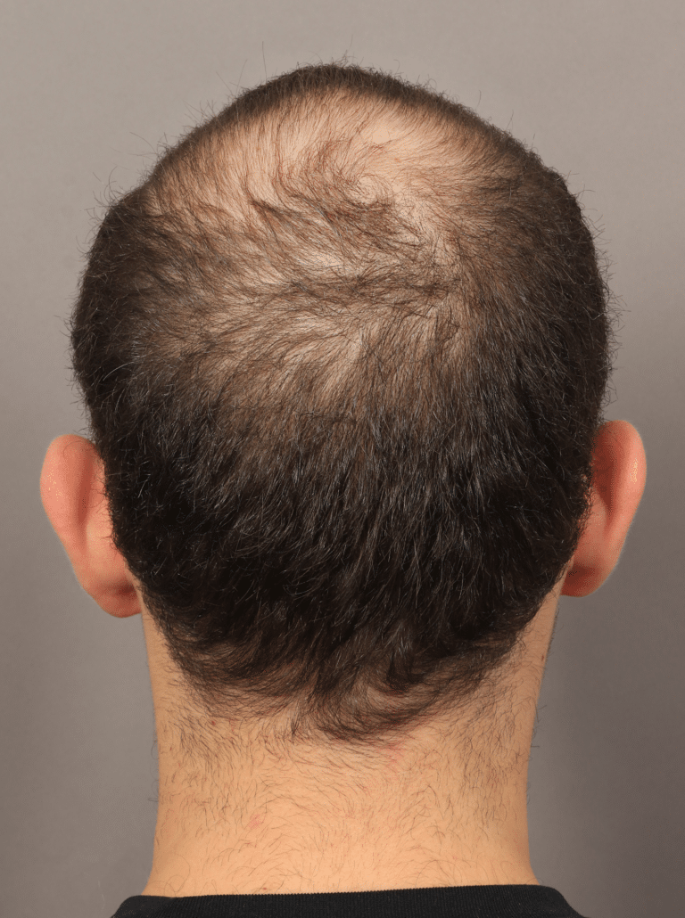 Before Image: NeoGraft Hair Transplant (7 Months Post-op) - back