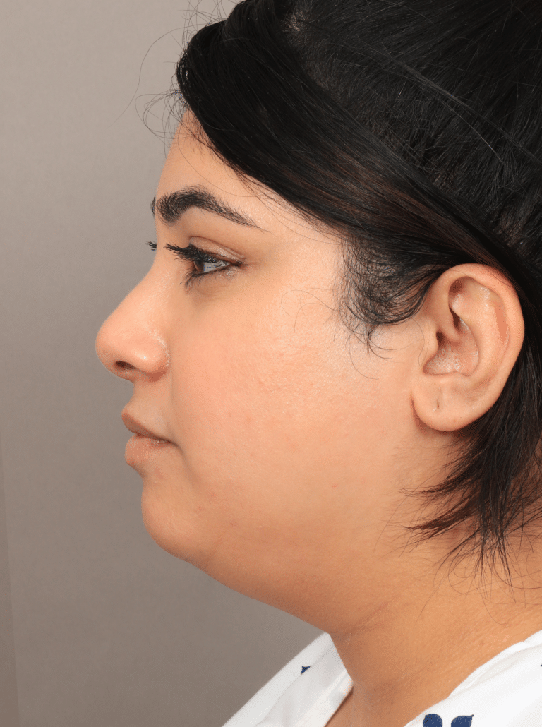 Before Image: Liposuction, Renuvion Skin Tightening, and Chin Implant (4 Month Post-op) - left-side