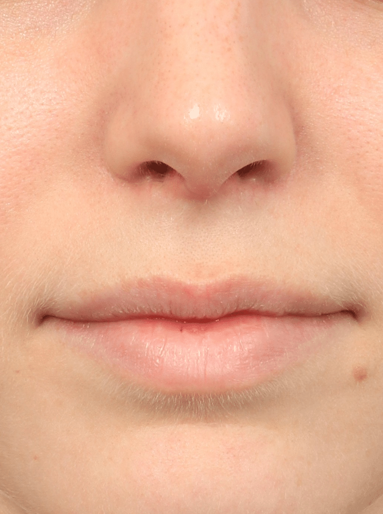 After Image: Rhinoplasty & Septoplasty (1 Month Post-op) - front