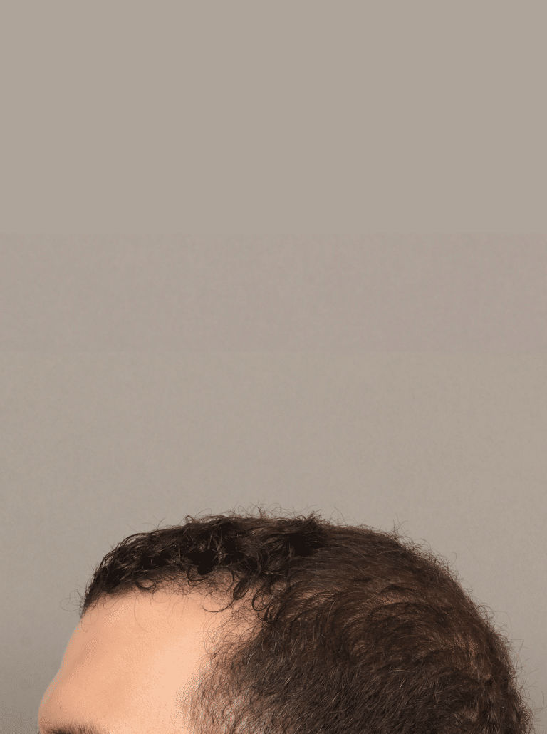 After Image: NeoGraft Hair Transplant (7 Months Post-op) - left-side