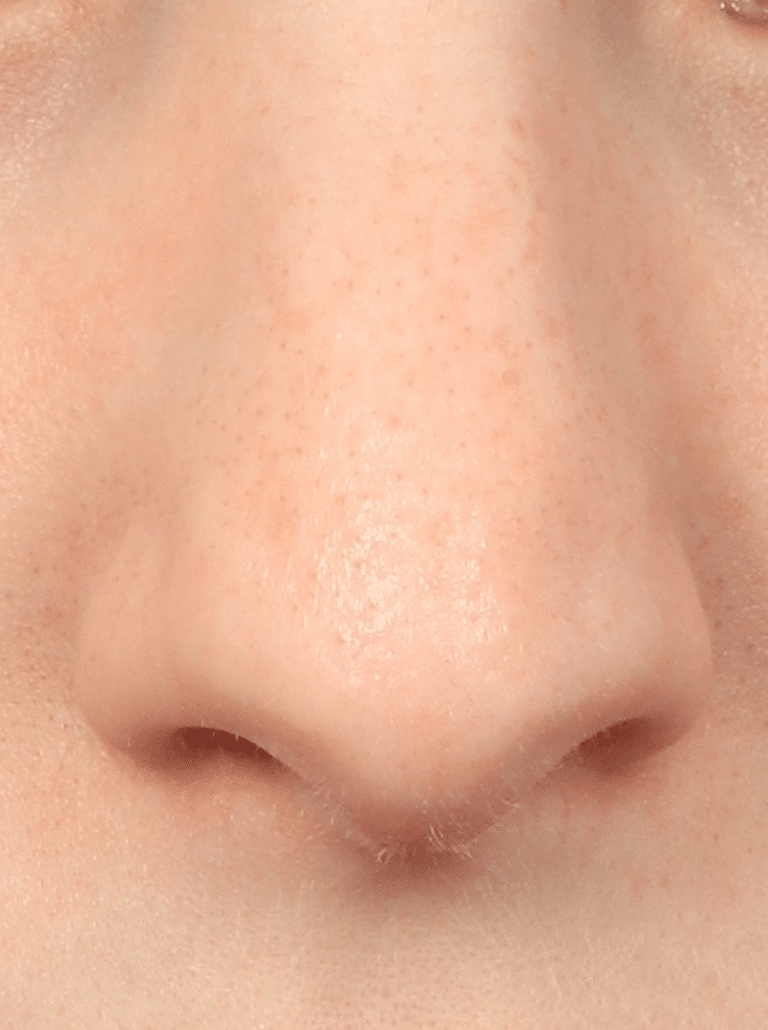 Before Image: Rhinoplasty & Septoplasty (1 Month Post-op) - front