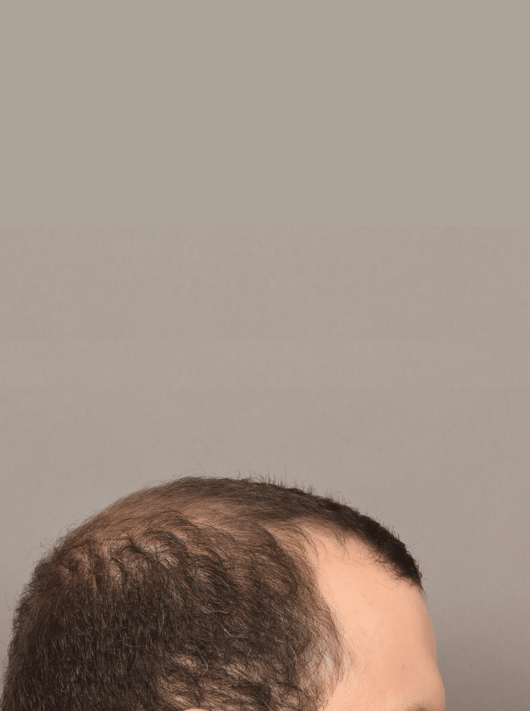 Before Image: NeoGraft Hair Transplant (7 Months Post-op) - right-side