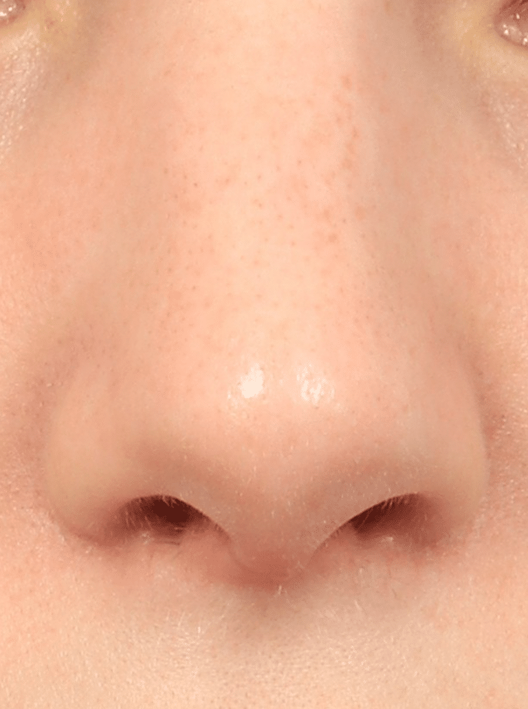 After Image: Rhinoplasty & Septoplasty (1 Month Post-op) - front