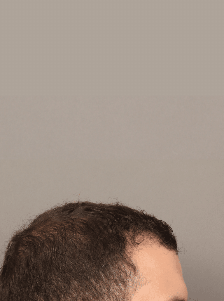 After Image: NeoGraft Hair Transplant (7 Months Post-op) - right-side