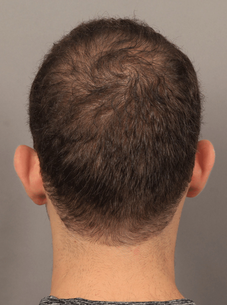 After Image: NeoGraft Hair Transplant (7 Months Post-op) - back