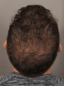 NeoGraft Hair Transplant (7 Months Post-op)