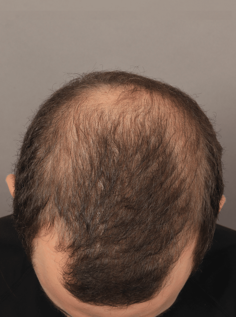 Before Image: NeoGraft Hair Transplant (7 Months Post-op) - front