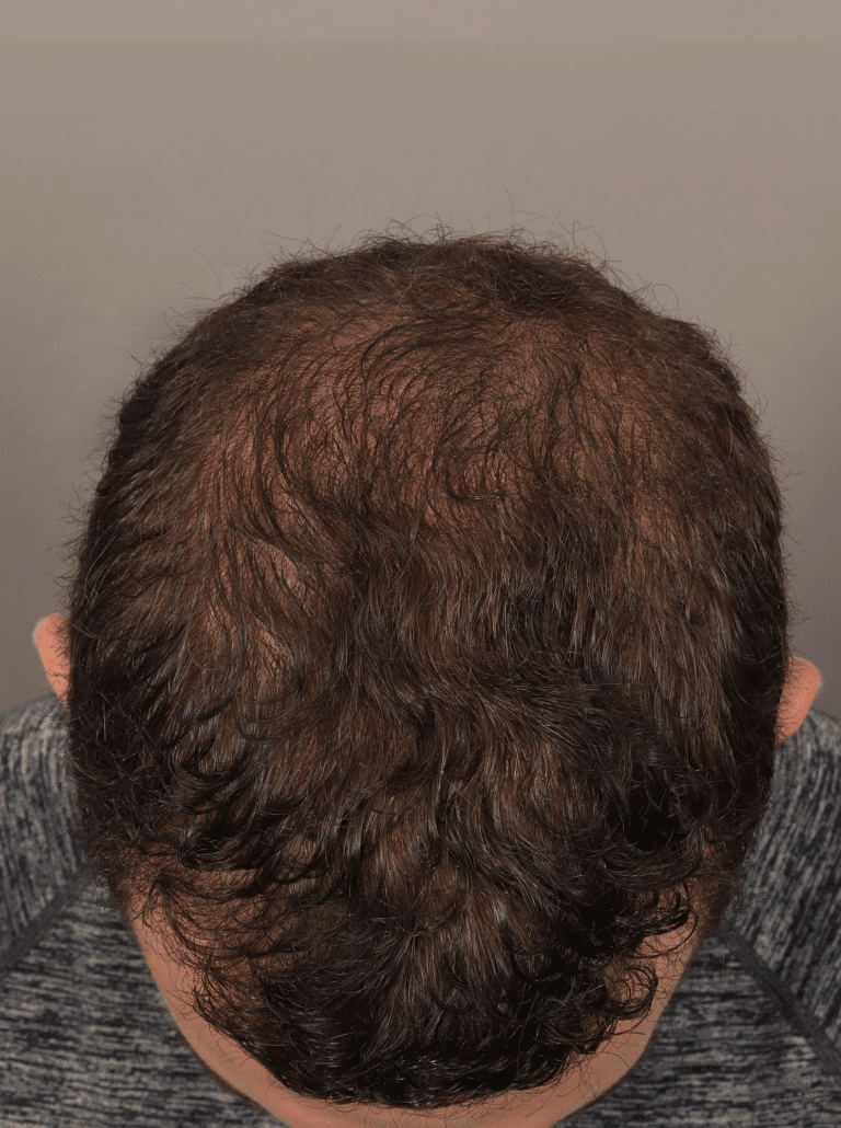 After Image: NeoGraft Hair Transplant (7 Months Post-op) - front