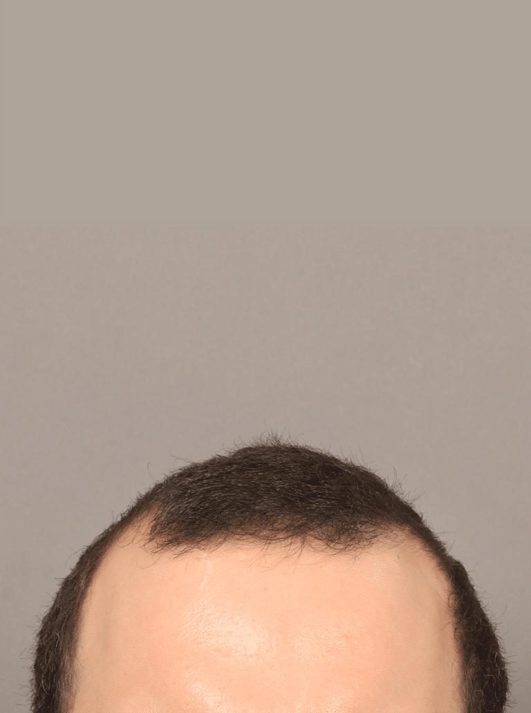 Before Image: NeoGraft Hair Transplant (7 Months Post-op) - front