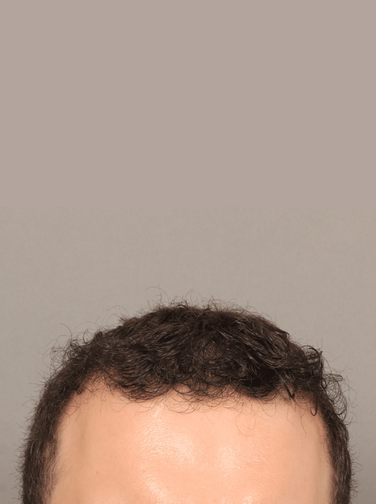 After Image: NeoGraft Hair Transplant (7 Months Post-op) - front