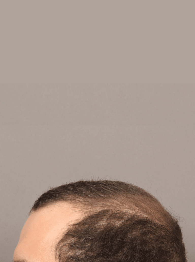 Before Image: NeoGraft Hair Transplant (7 Months Post-op) - left-side