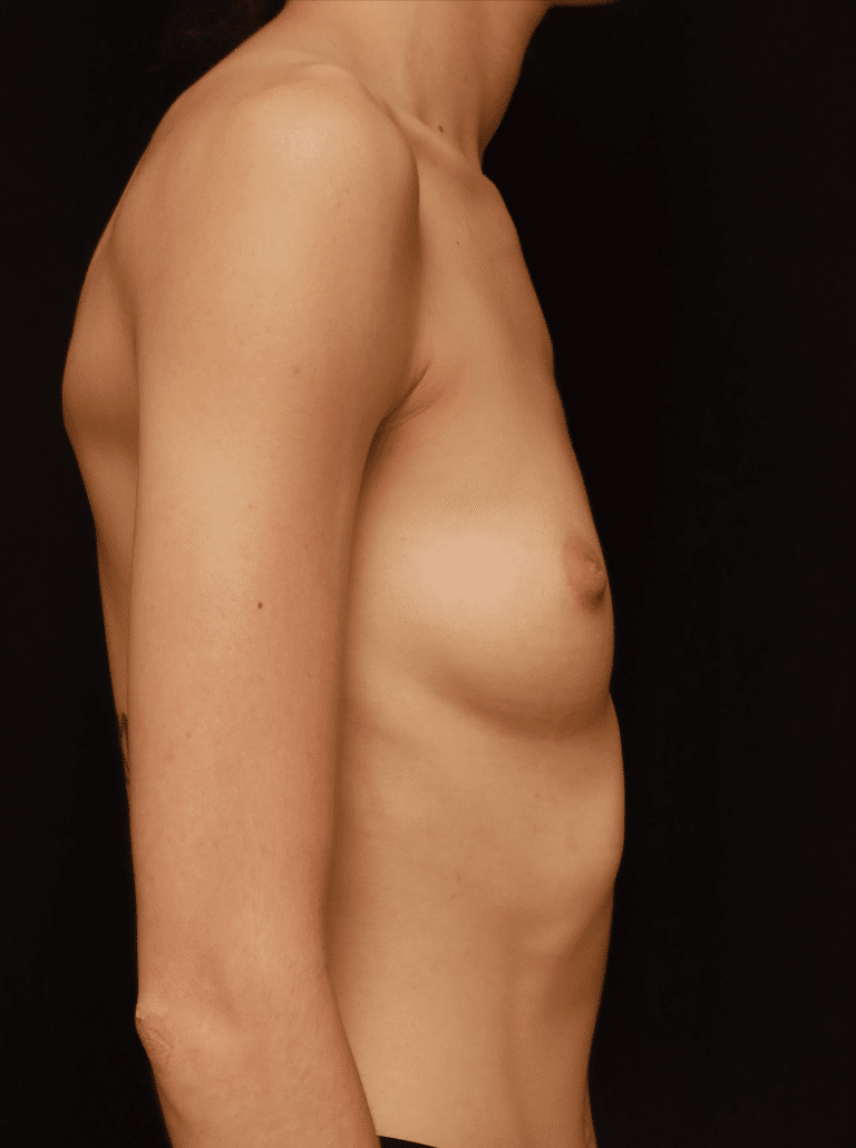 Before Image: Breast Augmentation (1 Year Post-op) - right-side