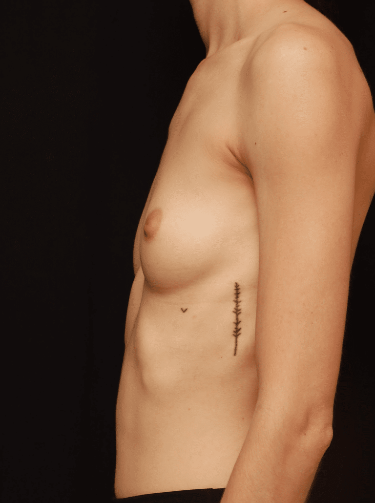 Before Image: Breast Augmentation (1 Year Post-op) - left-side