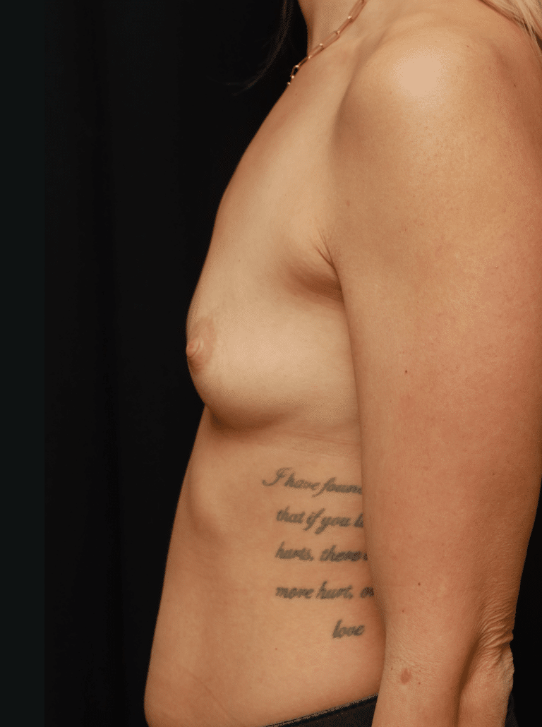 Before Image: Breast Augmentation (1 Year Post-op) - left-side